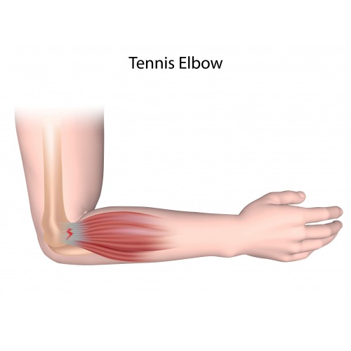 https://sunshinephysiotherapy.com/Case Study :Tennis Elbow  Pain Relief 